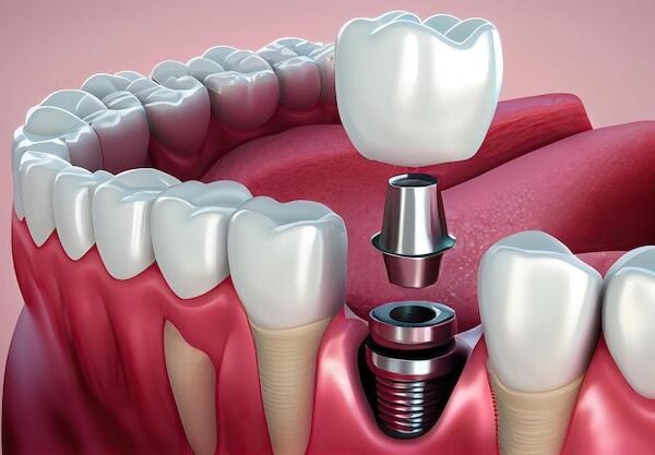 bulut dent
